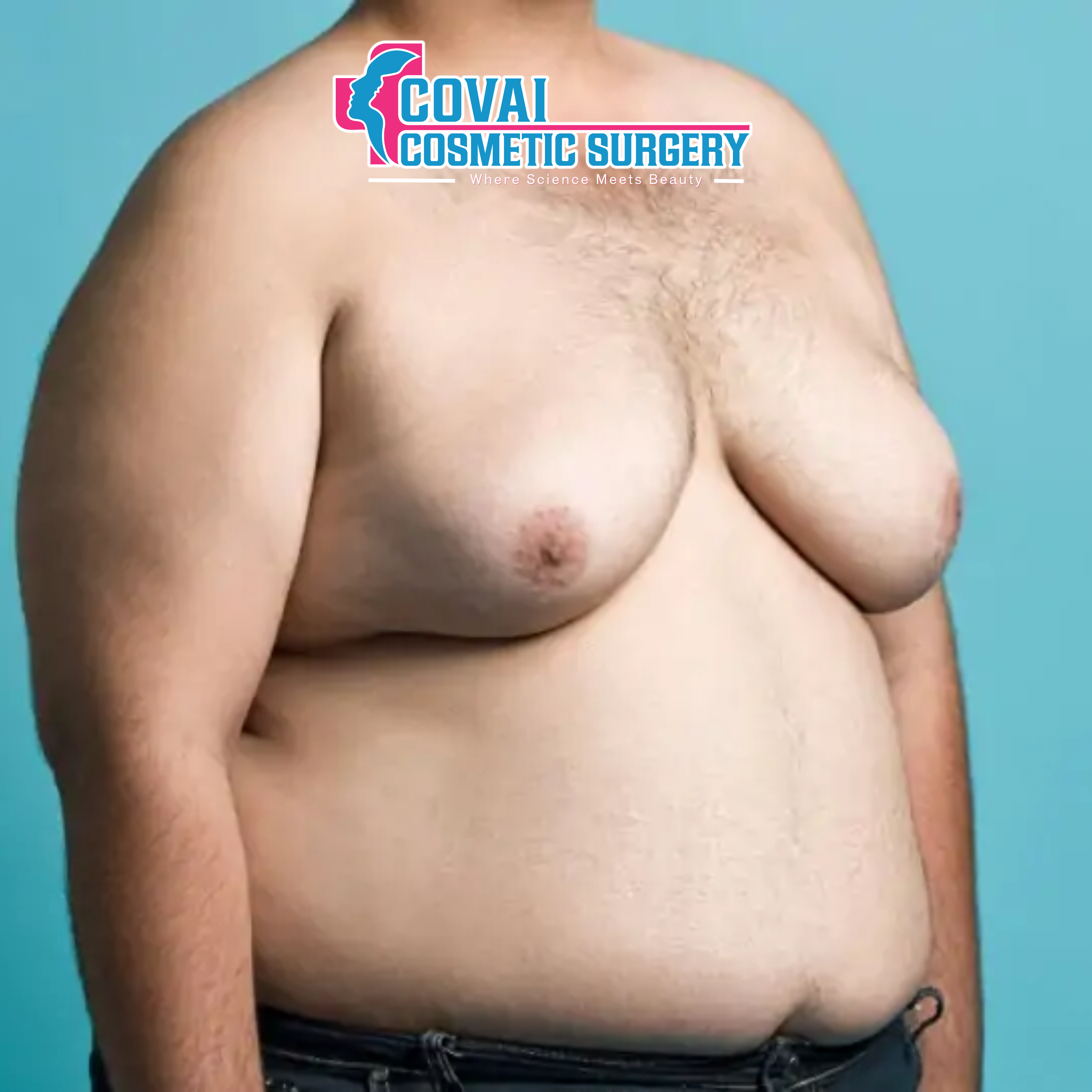 Female-like Chest